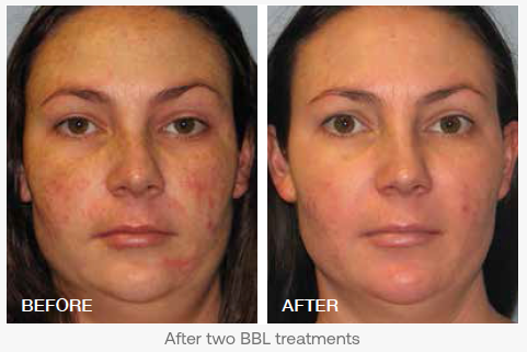 Broadband Light (BBL) - Full Face