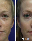 Broadband Light (BBL) - Face + Neck + Chest