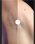 BBL Hair Removal - Underarms