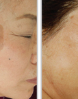 Broadband Light (BBL) - Face + Neck + Chest