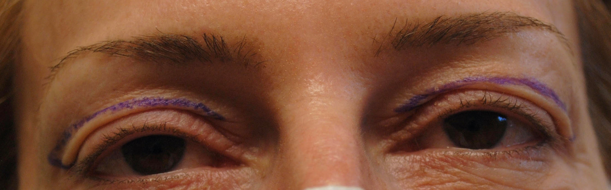 Blepharoplasty, In-Office Surgery for Upper Eyelid Heaviness