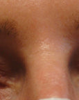 Blepharoplasty, In-Office Surgery for Upper Eyelid Heaviness
