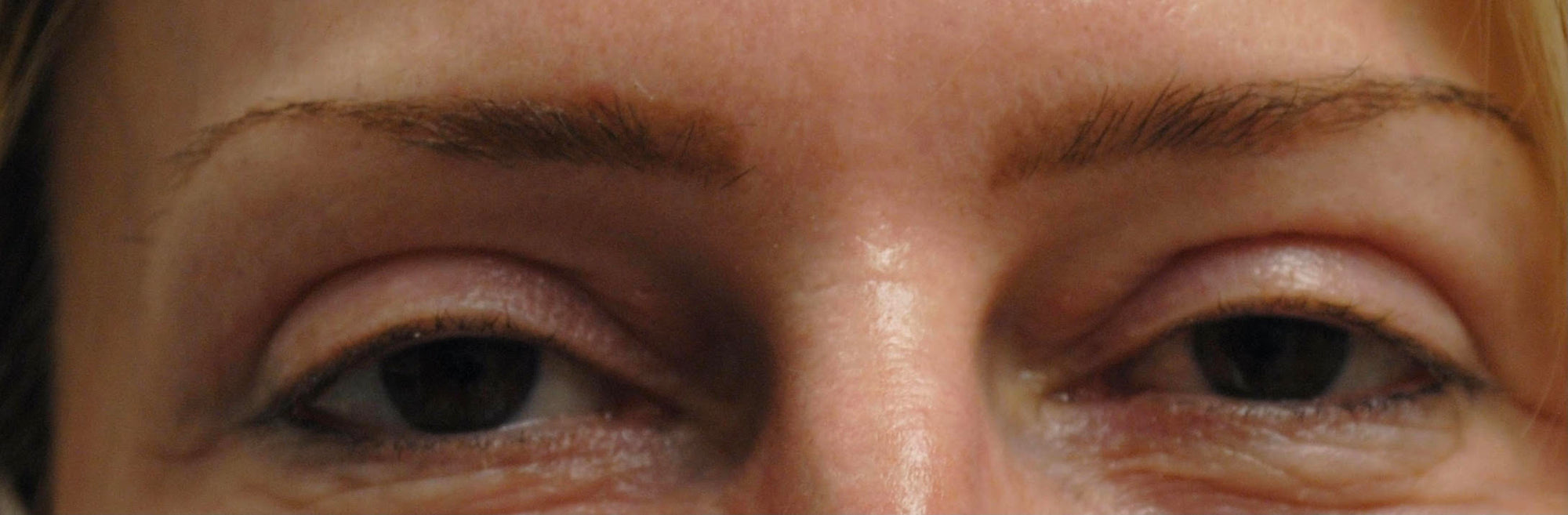 Blepharoplasty, In-Office Surgery for Upper Eyelid Heaviness