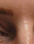 Blepharoplasty, In-Office Surgery for Upper Eyelid Heaviness