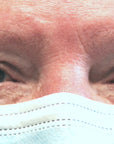 Blepharoplasty, In-Office Surgery for Upper Eyelid Heaviness