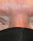 Blepharoplasty, In-Office Surgery for Upper Eyelid Heaviness