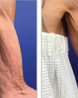 Halo + PRP crepey skin for thighs or arms