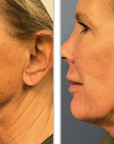 Halo + PRP, Face and Neck