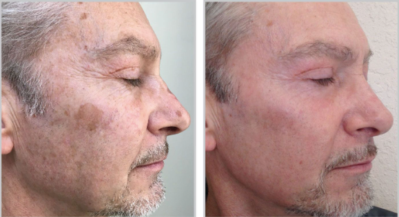 Halo + PRP, Face and Neck