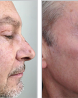 Halo + PRP, Face and Neck