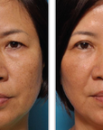 Halo + PRP, Face and Neck