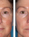 Halo + PRP, Face and Neck