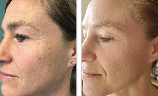 Halo + PRP, Face and Neck