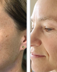 Halo + PRP, Face and Neck