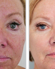 Halo + PRP, Face and Neck