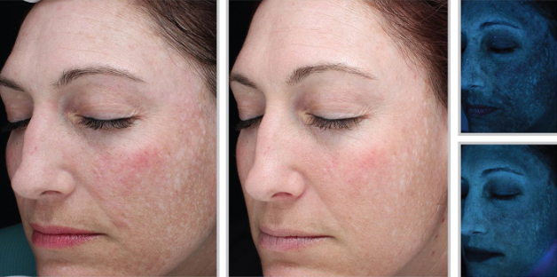 Halo + PRP - Face + Neck + Upper Chest