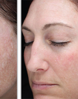 Halo + PRP - Full Face