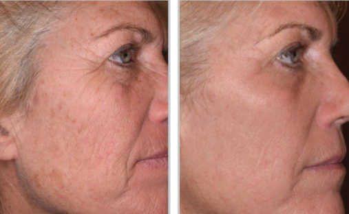 Halo + PRP, Face and Neck