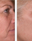 Halo + PRP, Face and Neck