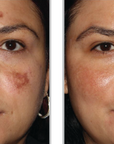 Halo + PRP - Full Face