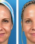 Halo + PRP - Full Face