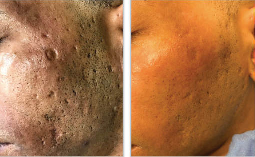 Halo + PRP - Full Face