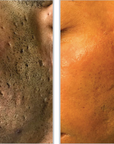 Halo + PRP - Full Face