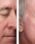 Halo + PRP, Face and Neck