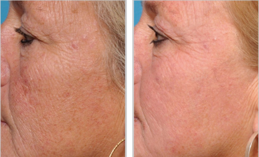 Halo + PRP, Face and Neck