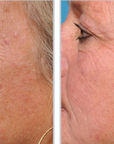 Halo + PRP, Face and Neck
