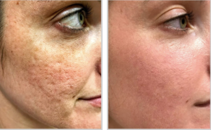 Halo + PRP - Full Face