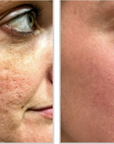 Halo + PRP - Full Face