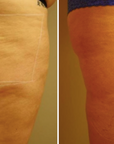 Halo + PRP crepey skin for thighs or arms