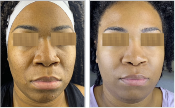 Halo + PRP, Face and Neck