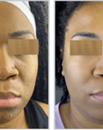 Halo + PRP, Face and Neck