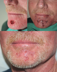 Mohs Surgery