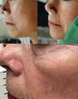 Mohs Surgery