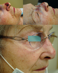 Mohs Surgery