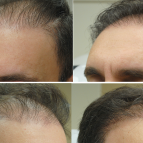 Hair Restoration with PRP