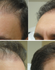 Hair Restoration with PRP