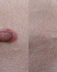 Injection of Lesions, same total price for up to 6 (Warts, Keloids, Scars, Keratoacanthomas)