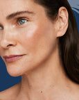 Radiesse Chin/Jaw Implant