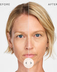 Radiesse Chin/Jaw Implant