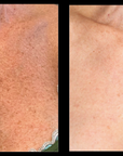 Broadband Light (BBL) - Shoulders to Elbows