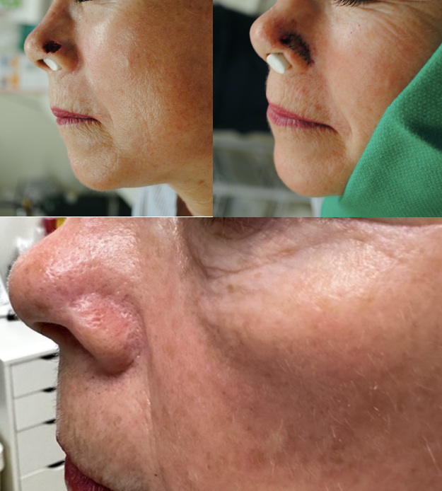 Mohs Surgery