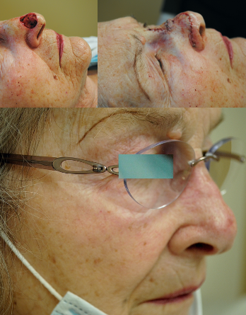 Mohs Surgery