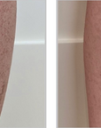 Broadband Light (BBL) - Elbows to Fingers