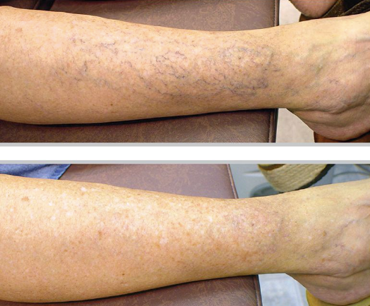 Broadband Light (BBL) - Broken Capillaries (Thighs + Legs)