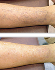 Broadband Light (BBL) - Broken Capillaries (Thighs + Legs)
