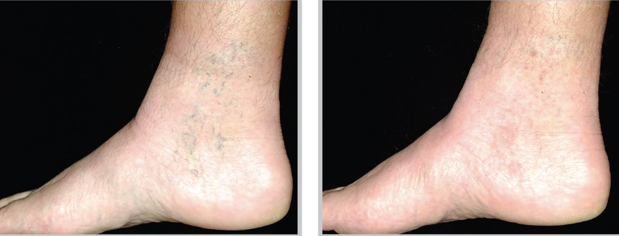 Broadband Light (BBL) - Broken Capillaries (Thighs + Legs)
